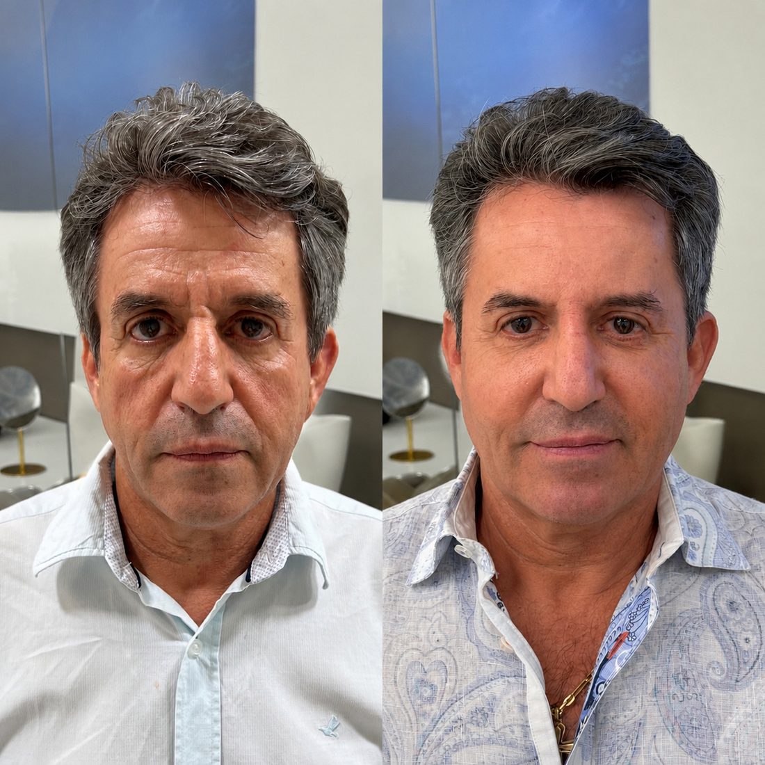 Antes e depois, paciente modelo 2