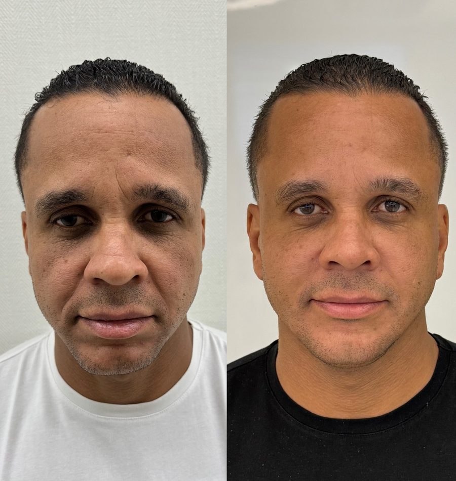 Antes e depois, paciente modelo 3