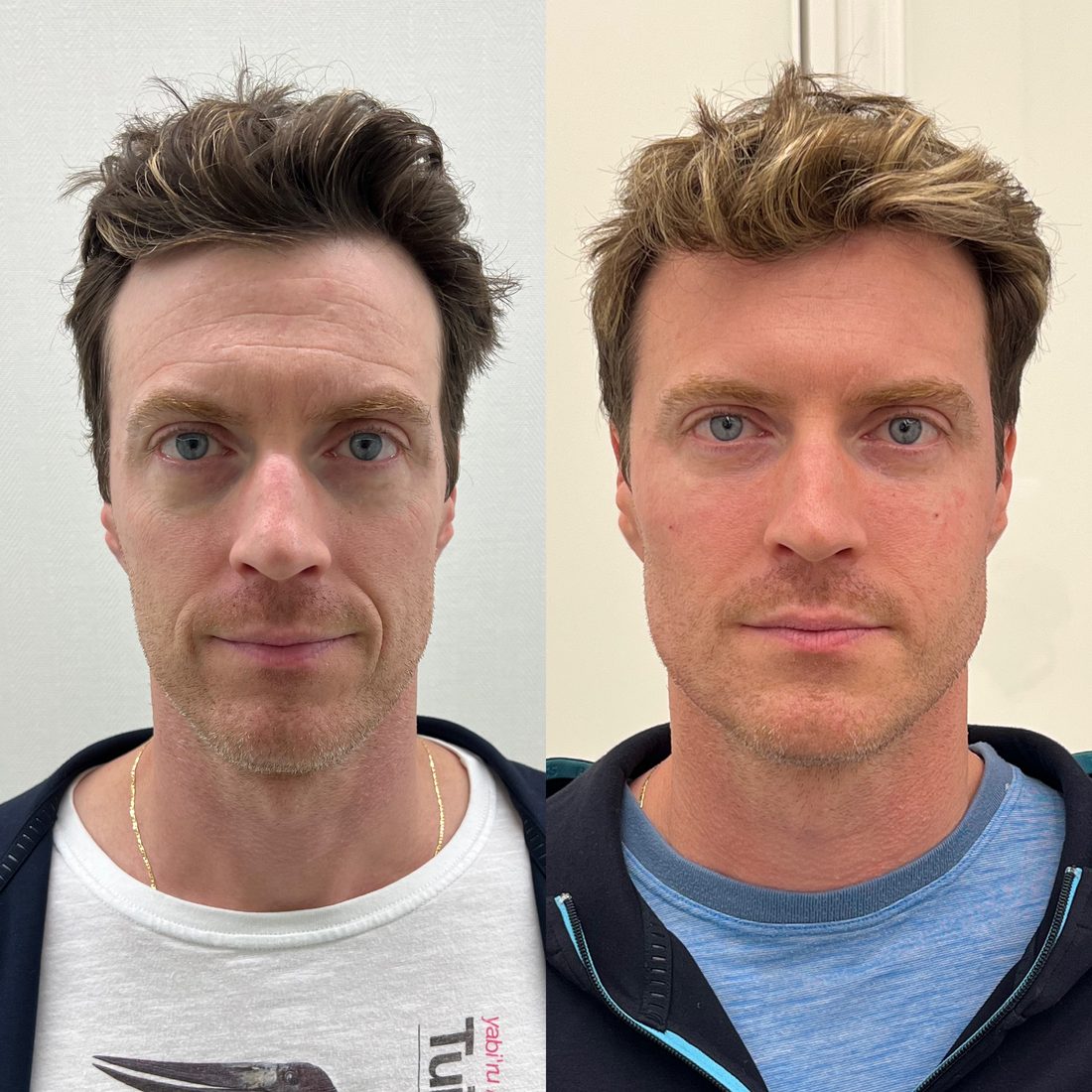 Antes e depois, paciente modelo 4