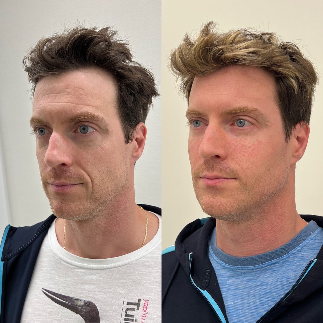 Antes e depois, paciente modelo 4, outro ângulo