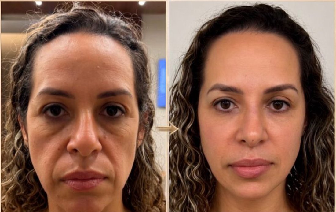Antes e depois de uma paciente modelo